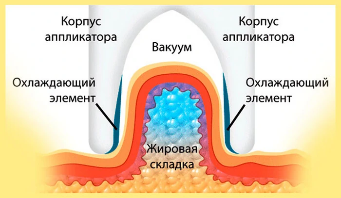 kryolipolýza